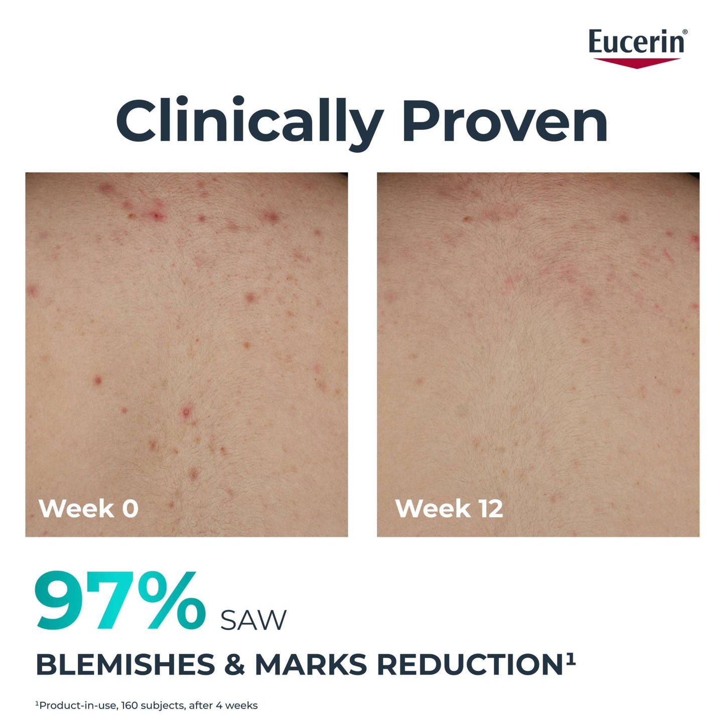 Eucerin DermoPure Clinical Correcting Body Cream 200ml - Additional 5